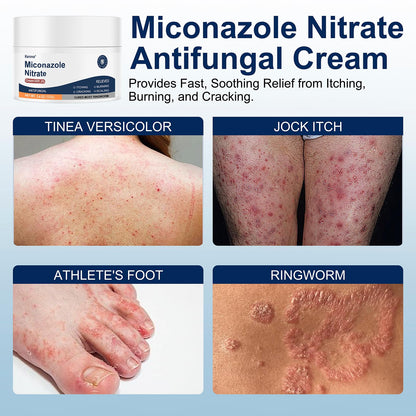 Kerova Antifungal Cream 2% Miconazole for Jock Itch, Athlete’s Foot & Ringworm – 3.5 oz