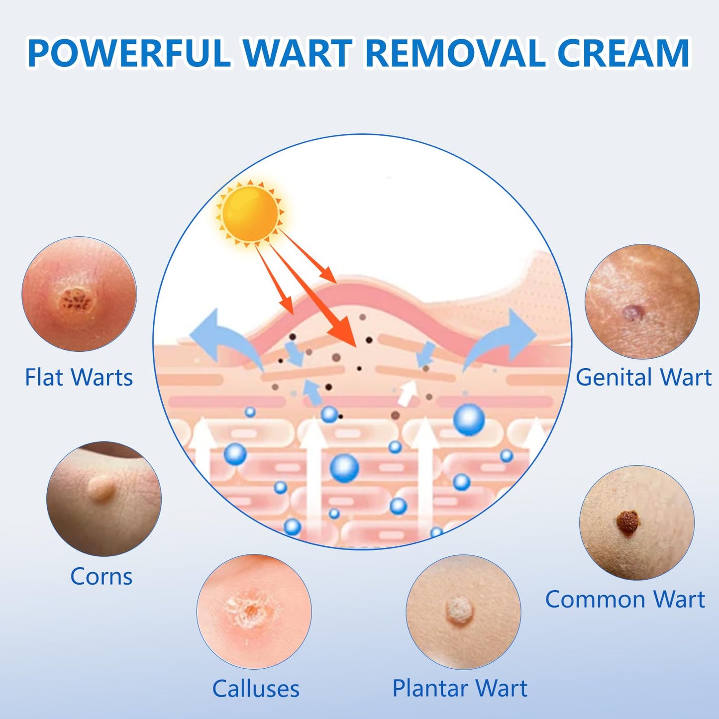KIbabyDI Wart Remover Gel – Fast Acting Freeze Treatment for Genital, Plantar, Common, Corn & Flat Warts (1 Pack, Red 10101)