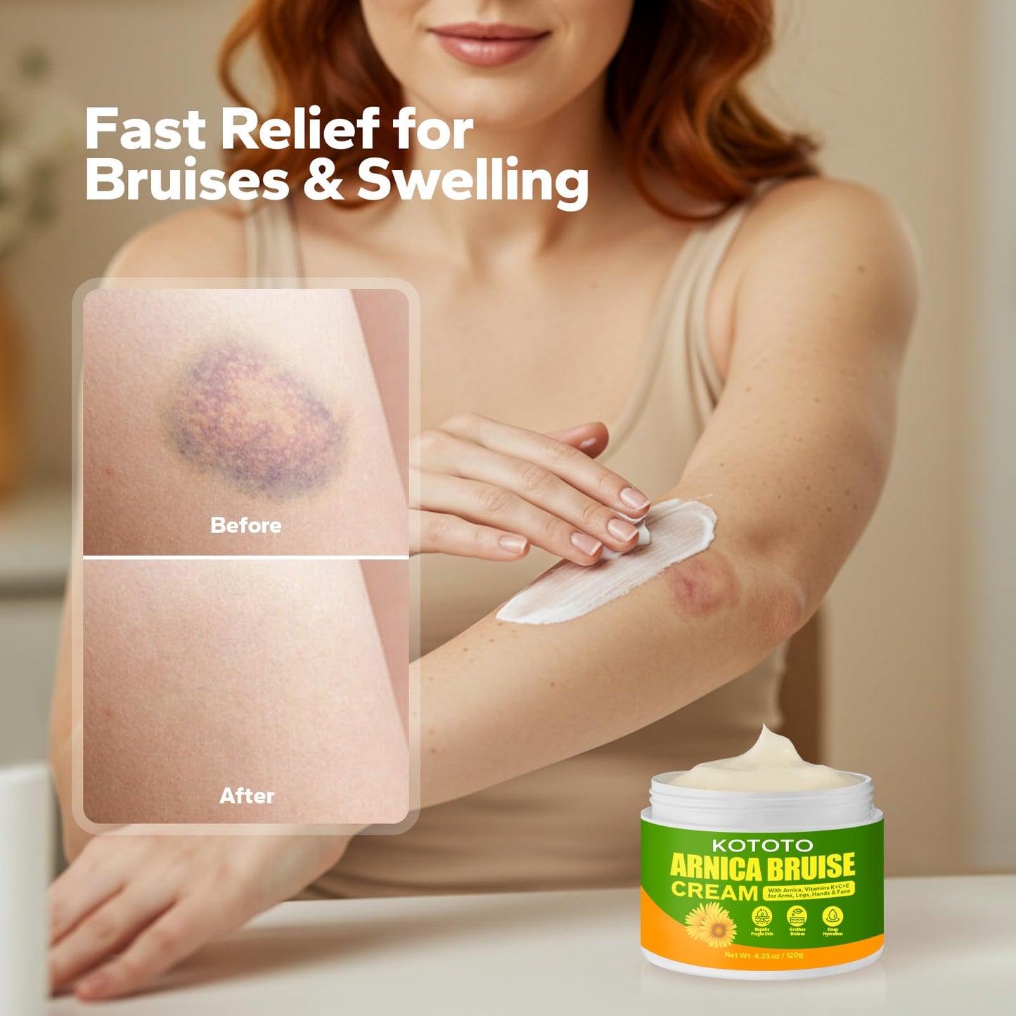 Kototo Arnica Gel for Bruising (4.2 Oz), Fast Relief for Bruises, Swelling & Discomfort, Natural Arnica Bruise Cream with Vitamin K & Herbal Extracts, Soothing Gel for Muscle & Joint