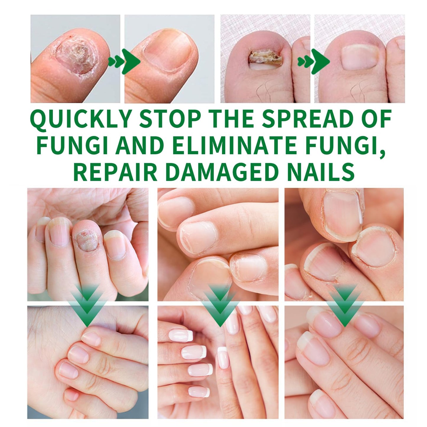 KUNLEN Nail Fungus Gel & Cream – 2pc Nail Repair Oil Serum