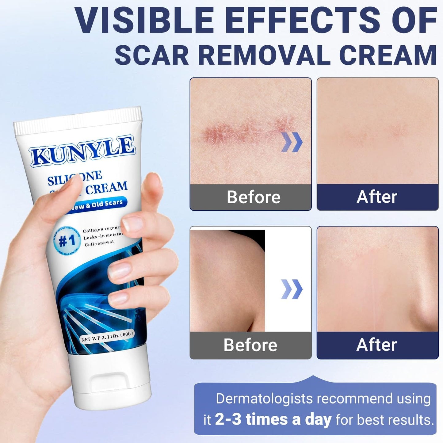 Kunyle Scar Cream – Silicone Scar Gel for Surgical Scars, Stretch Marks & Keloids (2.11 oz / 60 g)