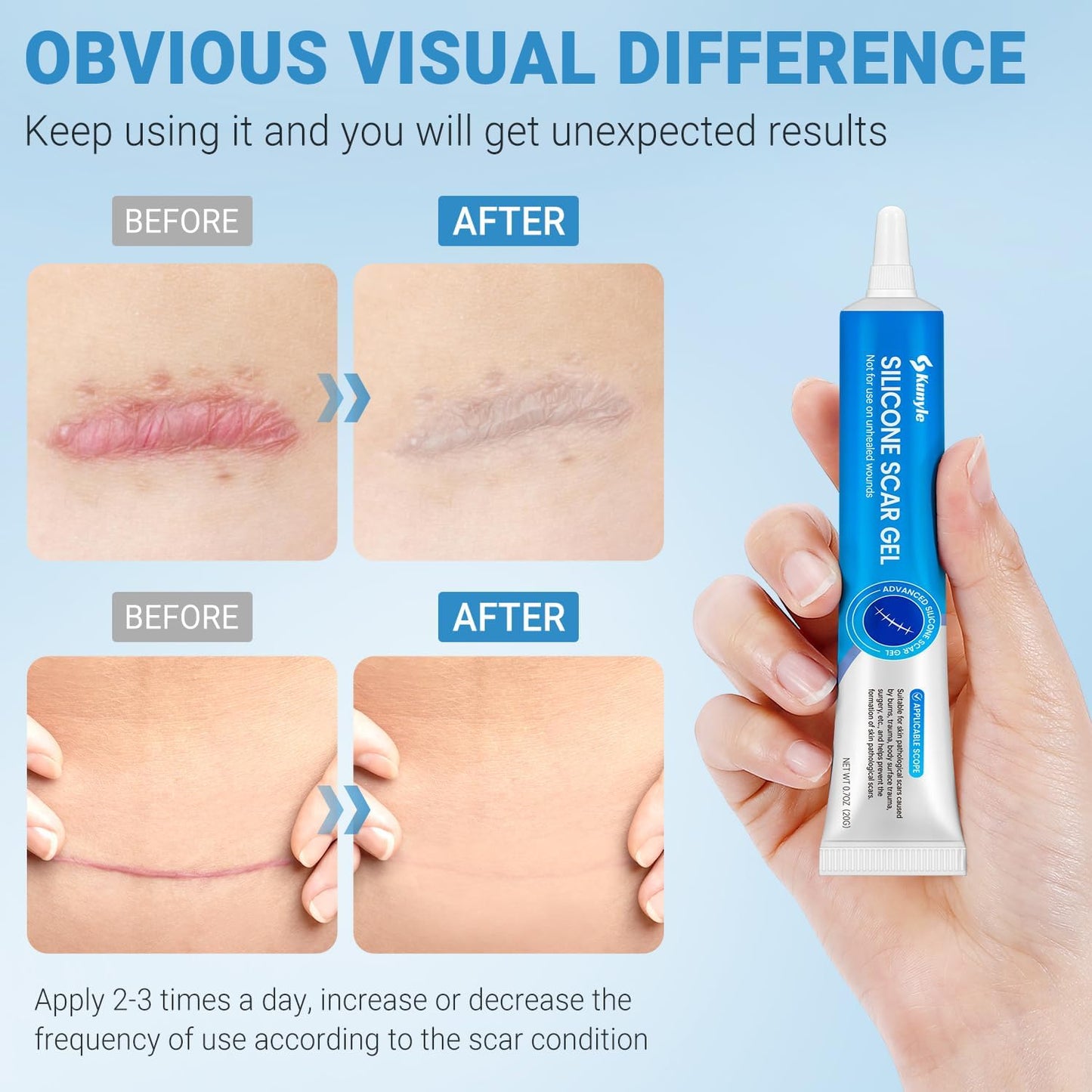 Kunyle Silicone Scar Gel – Advanced Scar Cream for Surgical Scars, Stretch Marks & Keloids | 0.70oz (20g)