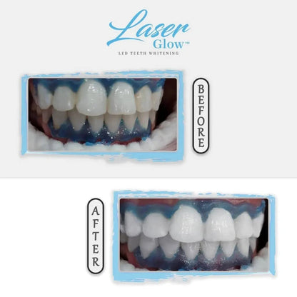 LaserGlow Professional Teeth Whitening Gel 44% Hydrogen Peroxide – Dual Barrel Syringe
