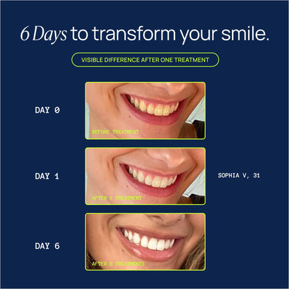 Laughland Teeth Whitening Kit – Phone-Powered LED Mouthpiece, 6+ Treatments for Sensitive Teeth