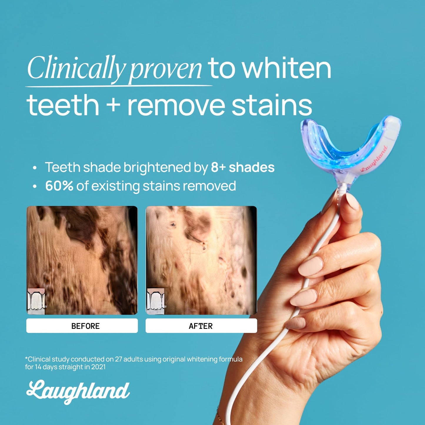 Laughland Super Strength Teeth Whitening Kit – Phone-Powered LED Mouthpiece