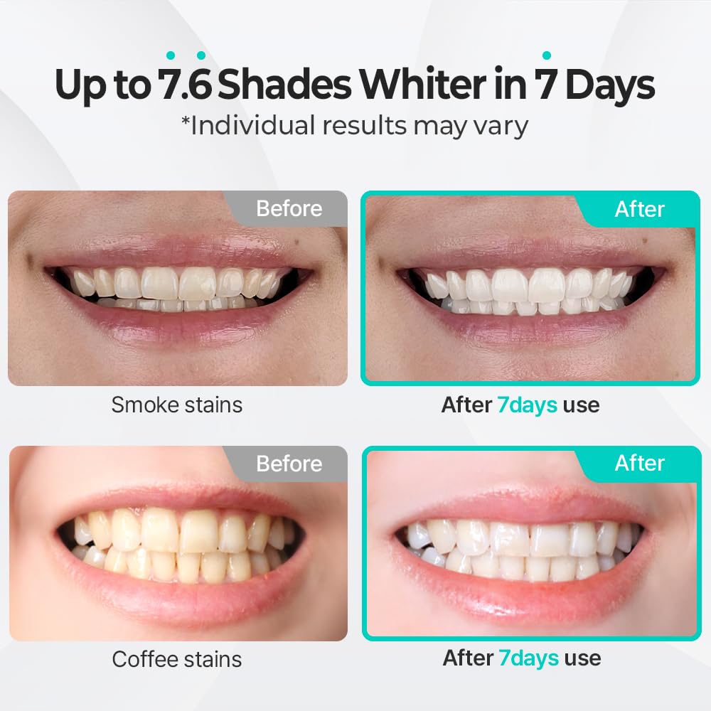 Live Orals PureDia Teeth Whitening Kit – Gel & Mouthpiece (28 Treatments) | Dentist-Formulated for Sensitive Teeth