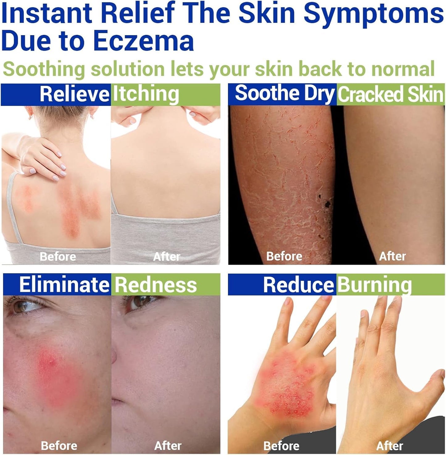 LMNOOP Eczema Cream - Maximum Strength Relief for Dry, Itchy Skin (7.05oz)