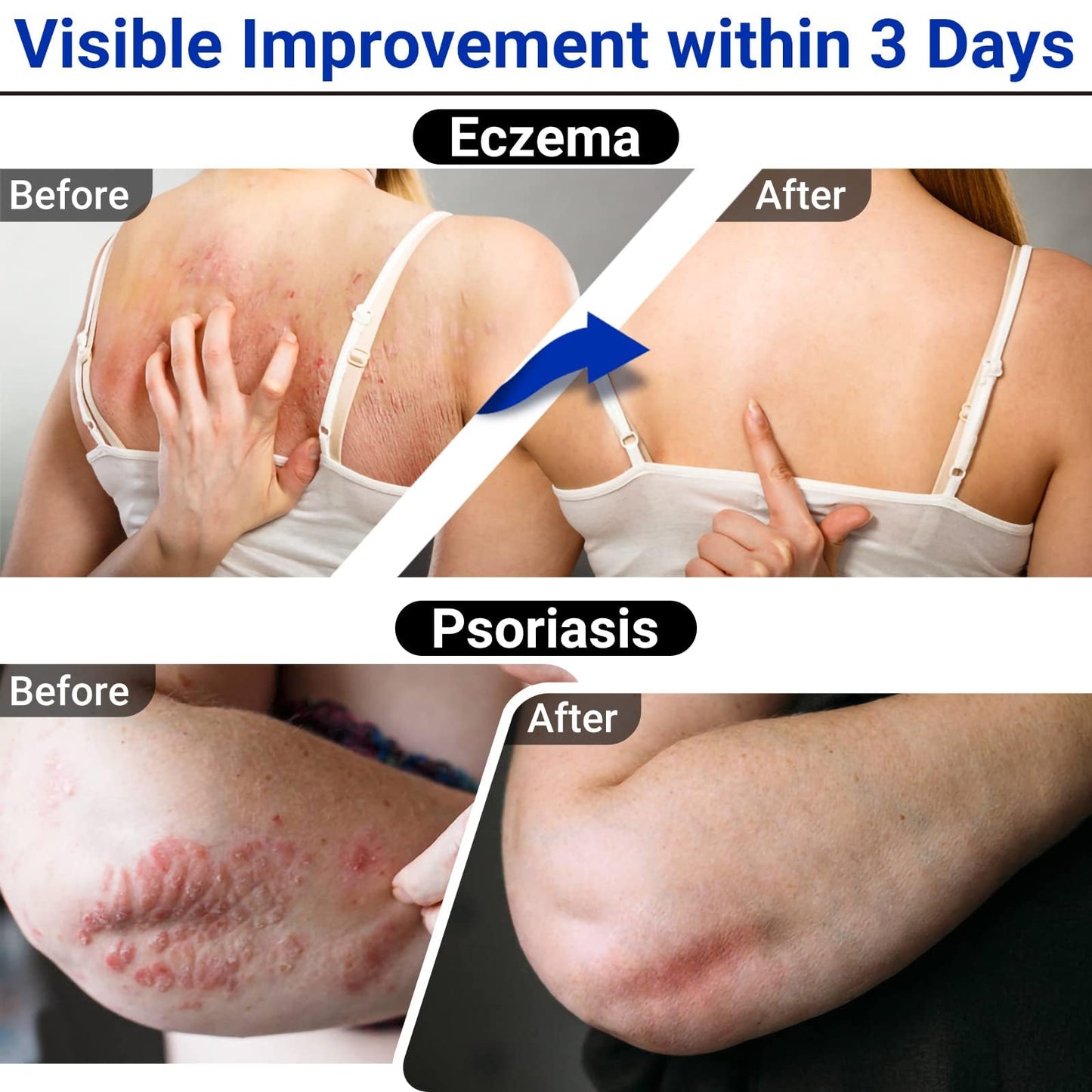 LMNOOP Eczema Cream – Maximum Strength Ointment for Dermatitis, Rash, Psoriasis & More | 2-Pack 1.76oz