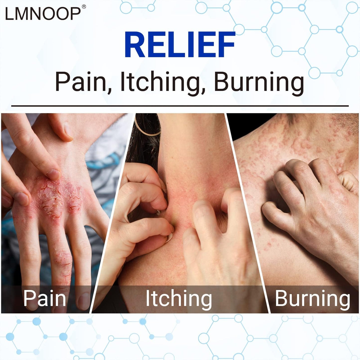 LMNOOP Eczema Cream – Maximum Strength Ointment for Dermatitis, Rash, Psoriasis & More | 2-Pack 1.76oz