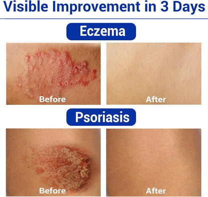 LMNOOP Eczema Cream - Maximum Strength Relief for Dry, Itchy Skin (7.05oz)