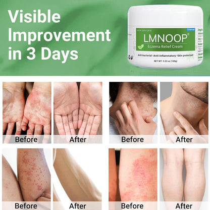 LMNOOP Eczema Cream — Maximum Strength Itch Relief for Dry, Irritated Skin (3.53oz)