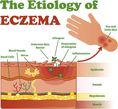 LMNOOP Eczema Cream — Maximum Strength Itch Relief for Dry, Irritated Skin (3.53oz)