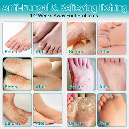 LMNOOP Athletes Foot Treatment Cream | Maximum Strength Fungal Relief