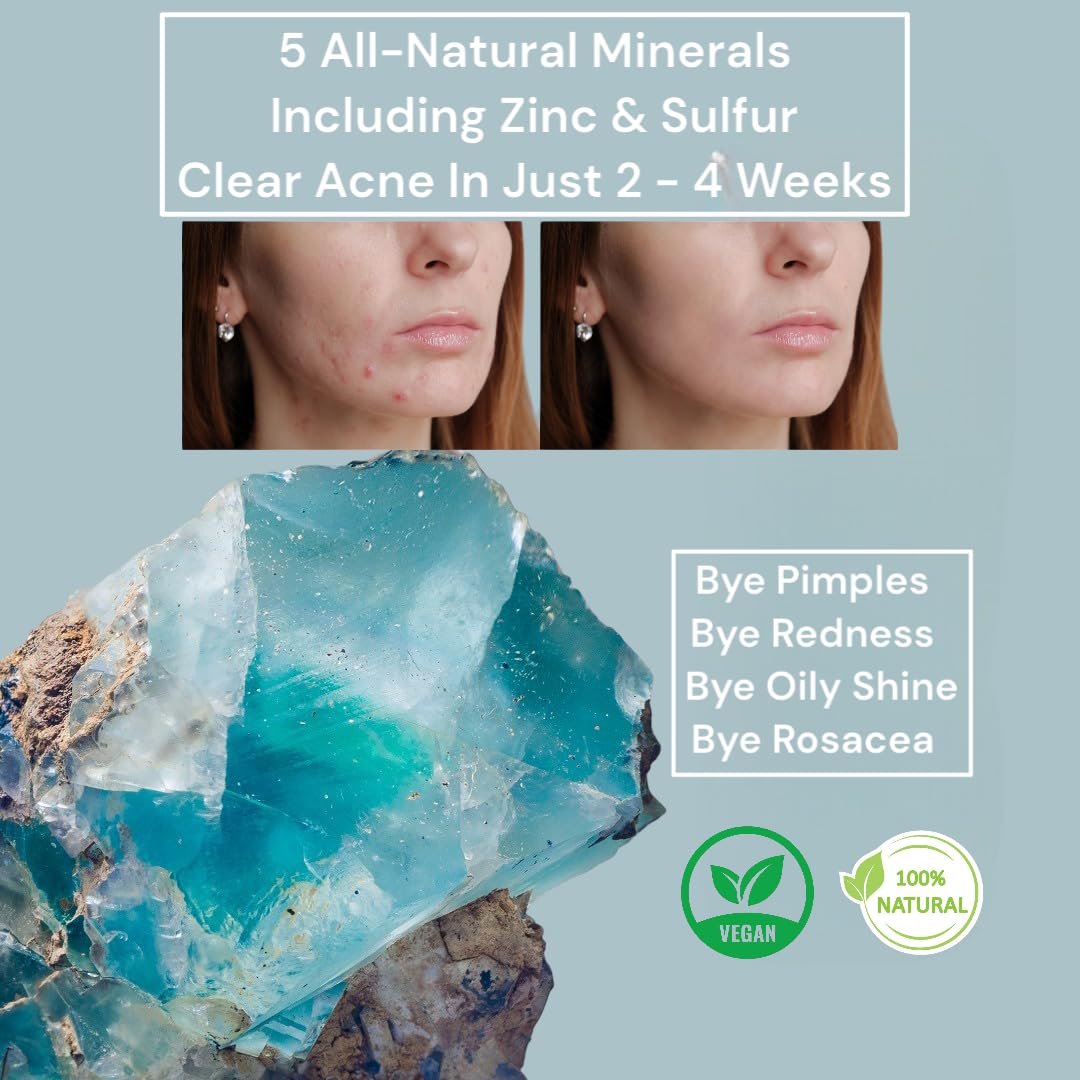 Loma Lux Acne Pills – Natural Mineral Acne Support with Zinc & Sulfur | Dermatologist Developed Oral Acne Treatment