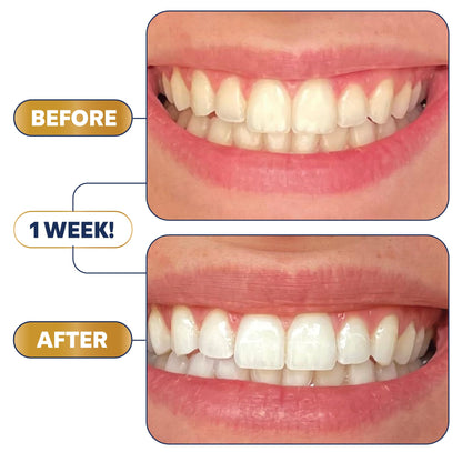 Lumineux Ultimate Whitening Kit Bundle – Enamel Safe & Clinically Proven