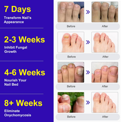 Marianp Toenail Patches Extra Strength – 24 Nighttime Nail Patches