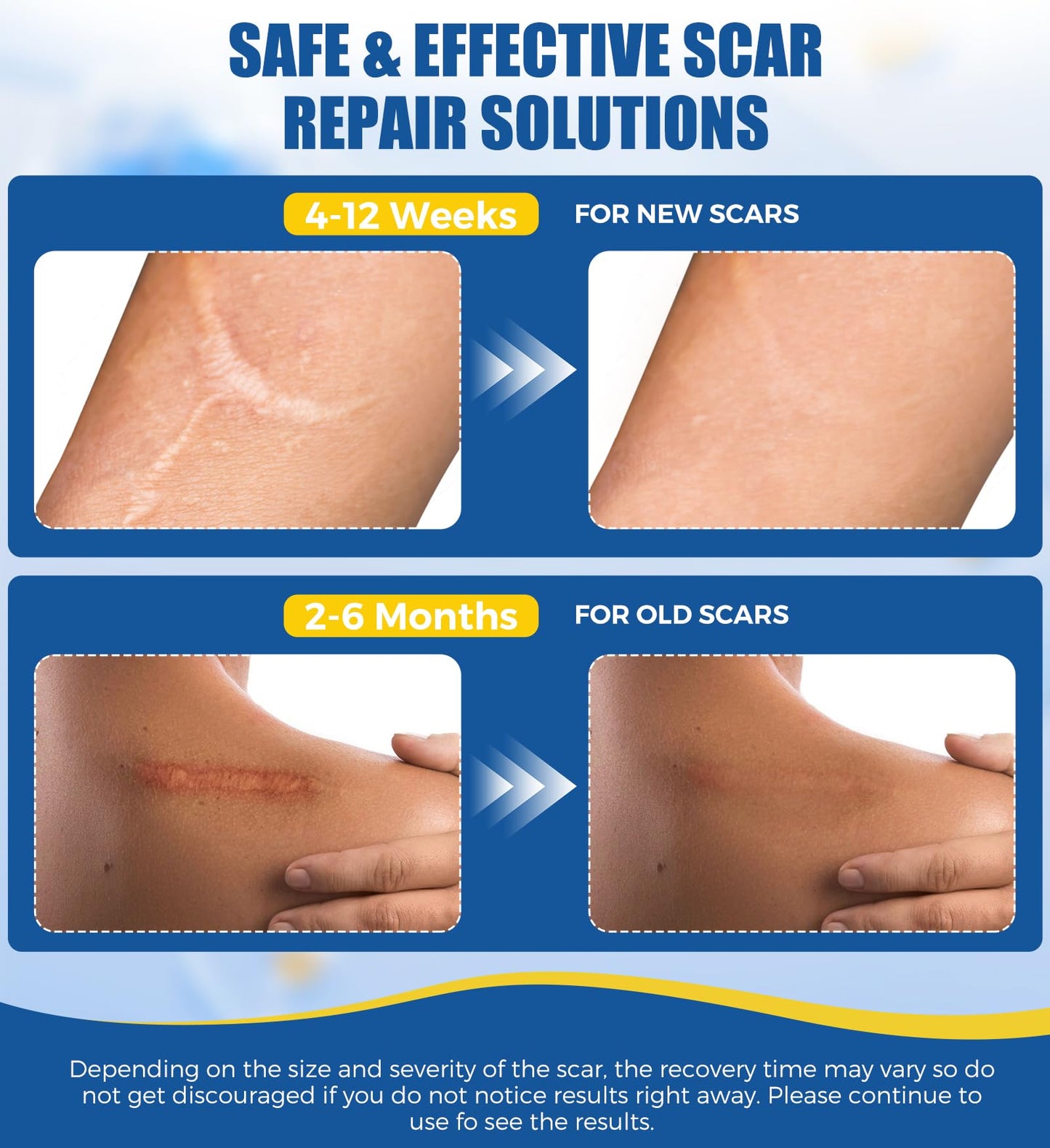 MasterMo Medical Grade Silicone Scar Sheets & Tape – 1.6x60 Roll, Ultra Soft & Hypoallergenic