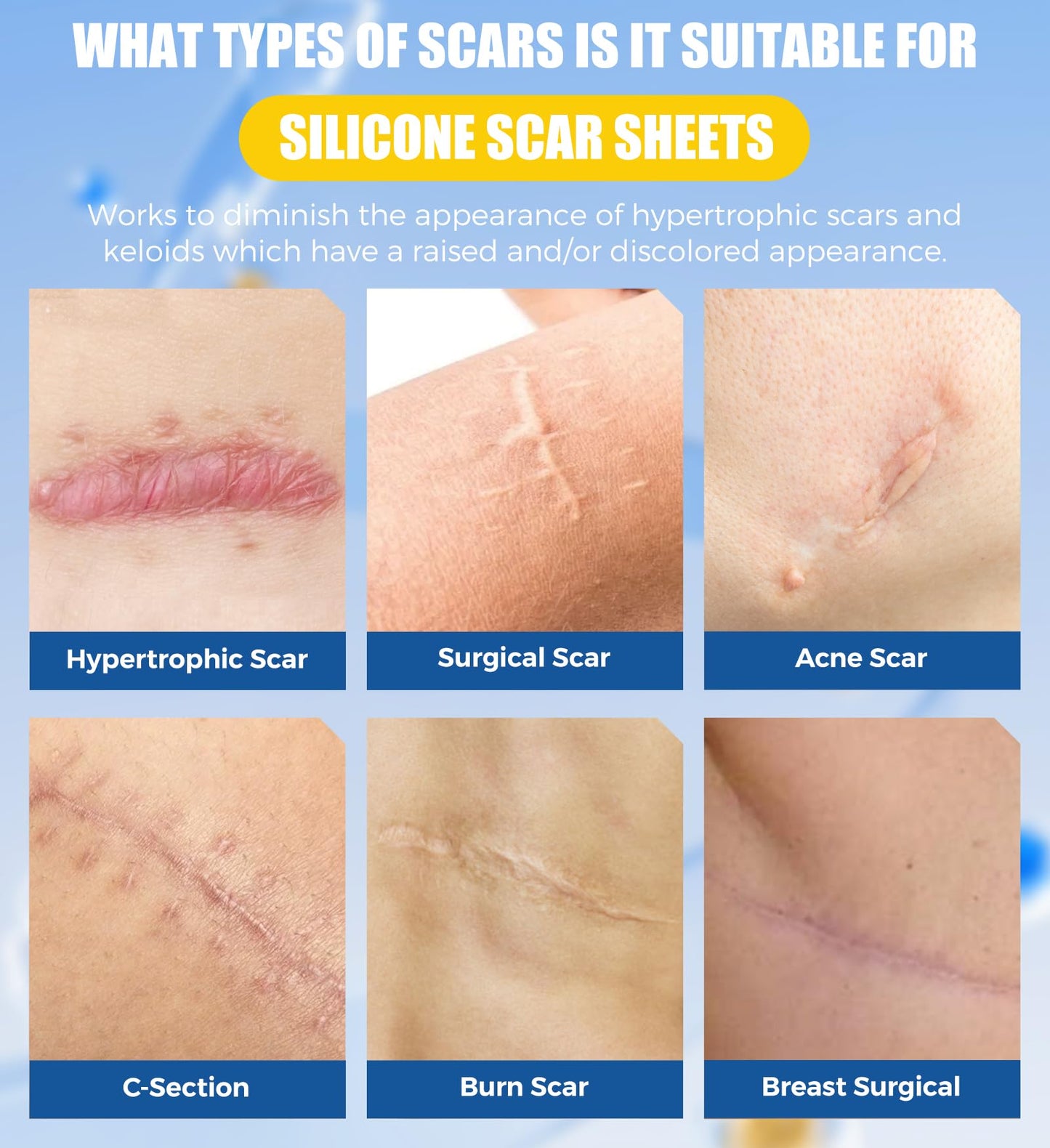 MasterMo Medical Grade Silicone Scar Sheets & Tape – 1.6x60 Roll, Ultra Soft & Hypoallergenic