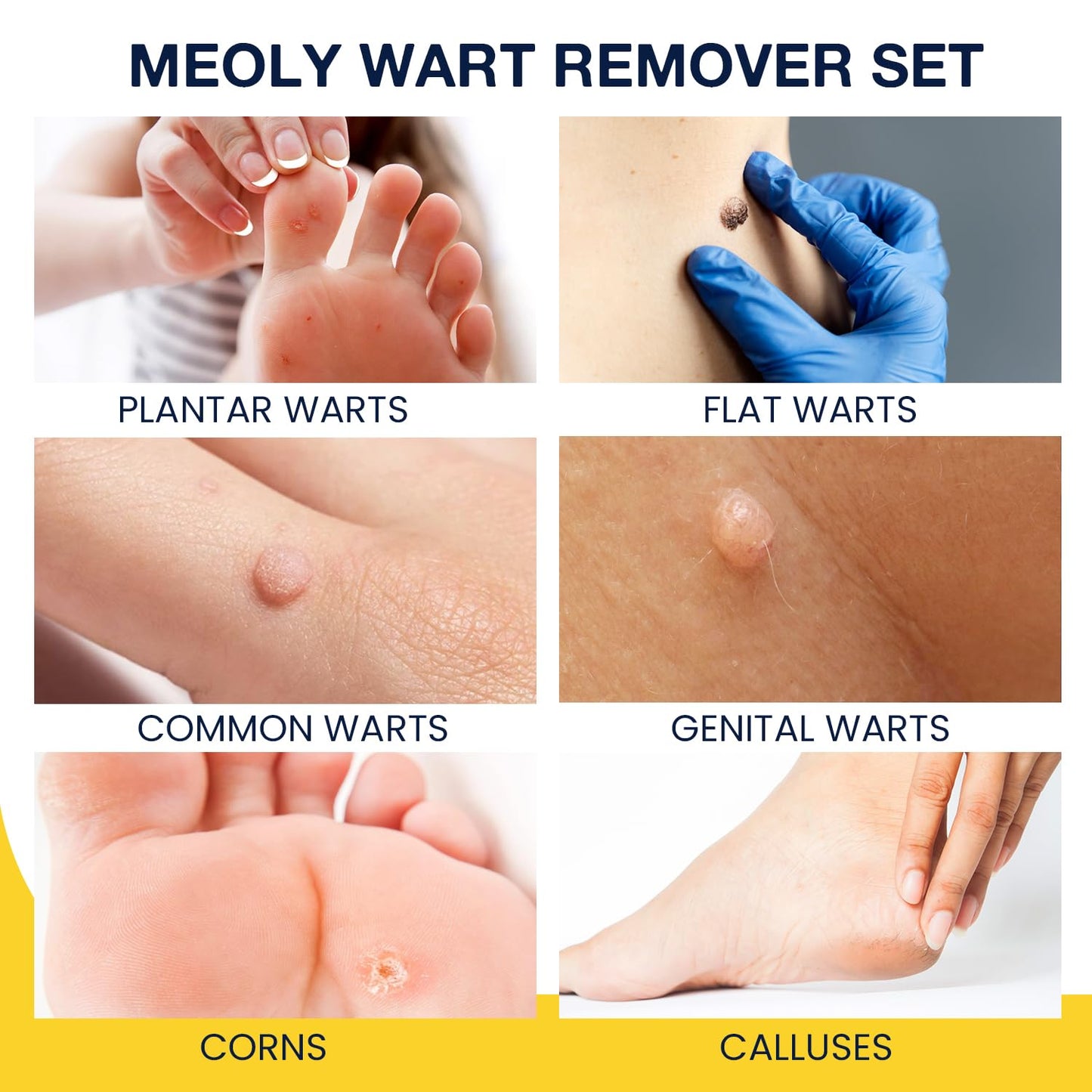 MEOLY Plantar Wart Remover Set - Maximum Strength Salicylic Acid, 12 Thick Cushioning Pads