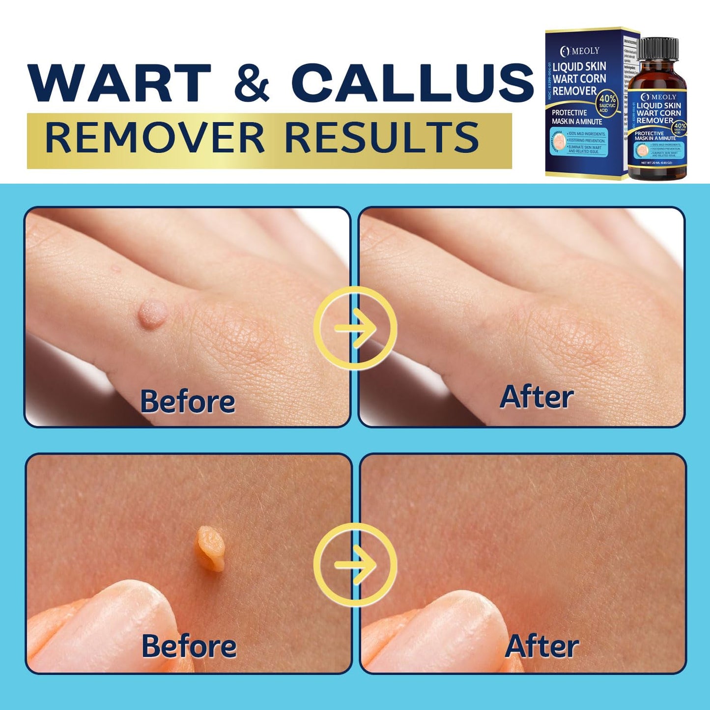 MEOLY Fast-Acting Wart Remover – 40% Salicylic Acid for Plantar Warts & Corns