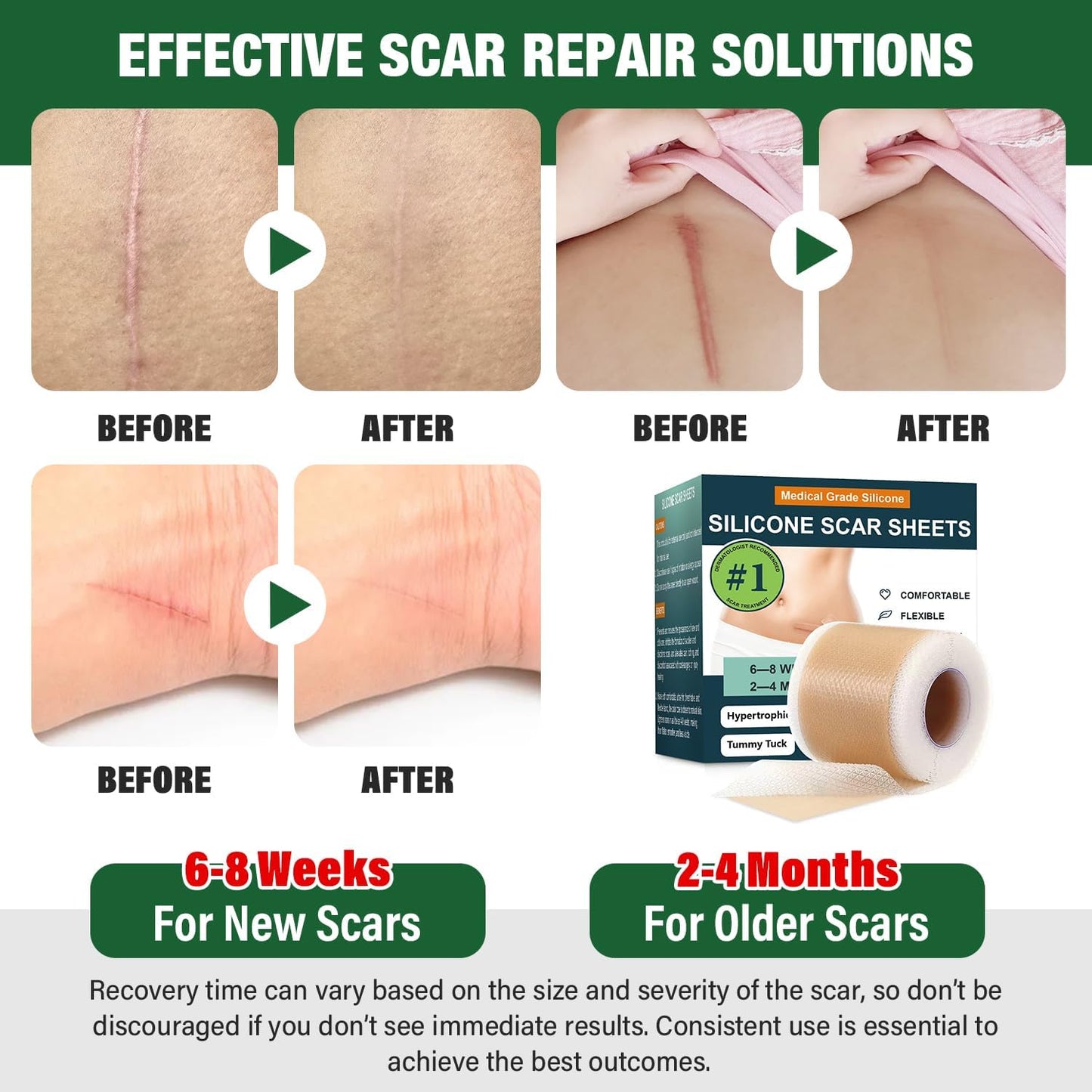 Micakin Silicone Scar Sheets & Tape — 1.6x120 in Roll (3M)
