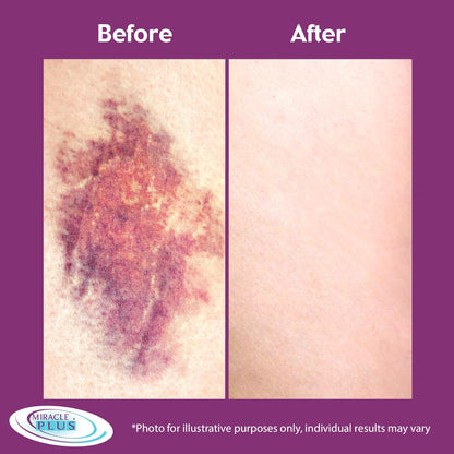 Miracle Plus Arnica Cream Extra Strength – Bruise Relief Lotion (2-Pack)