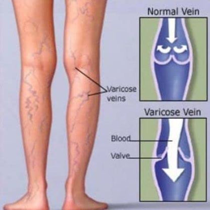 Mivolis Vein Gel with Horse Chestnut Extract & Eucalyptus Oil – 100 ml