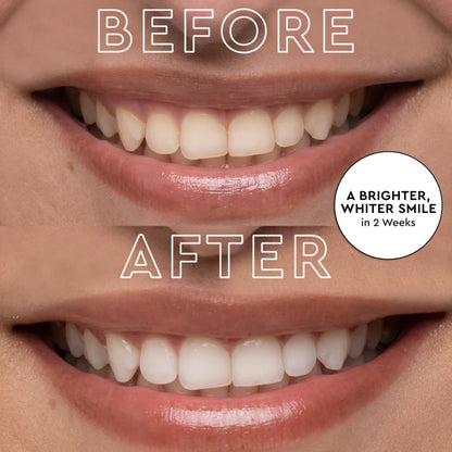 MOON Teeth Whitening Kit - LED Light Device, 56 Strips, 12 Shades in 2 Weeks