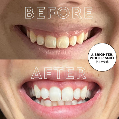 MOON Teeth Whitening Kit — LED Light Therapy, 18-Shade Whitening (4-Piece Kit)