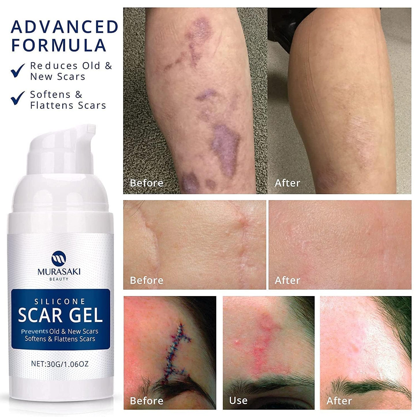 MURASAKI BEAUTY 100% Silicone Scar Gel – Maximum-Strength Scar Cream