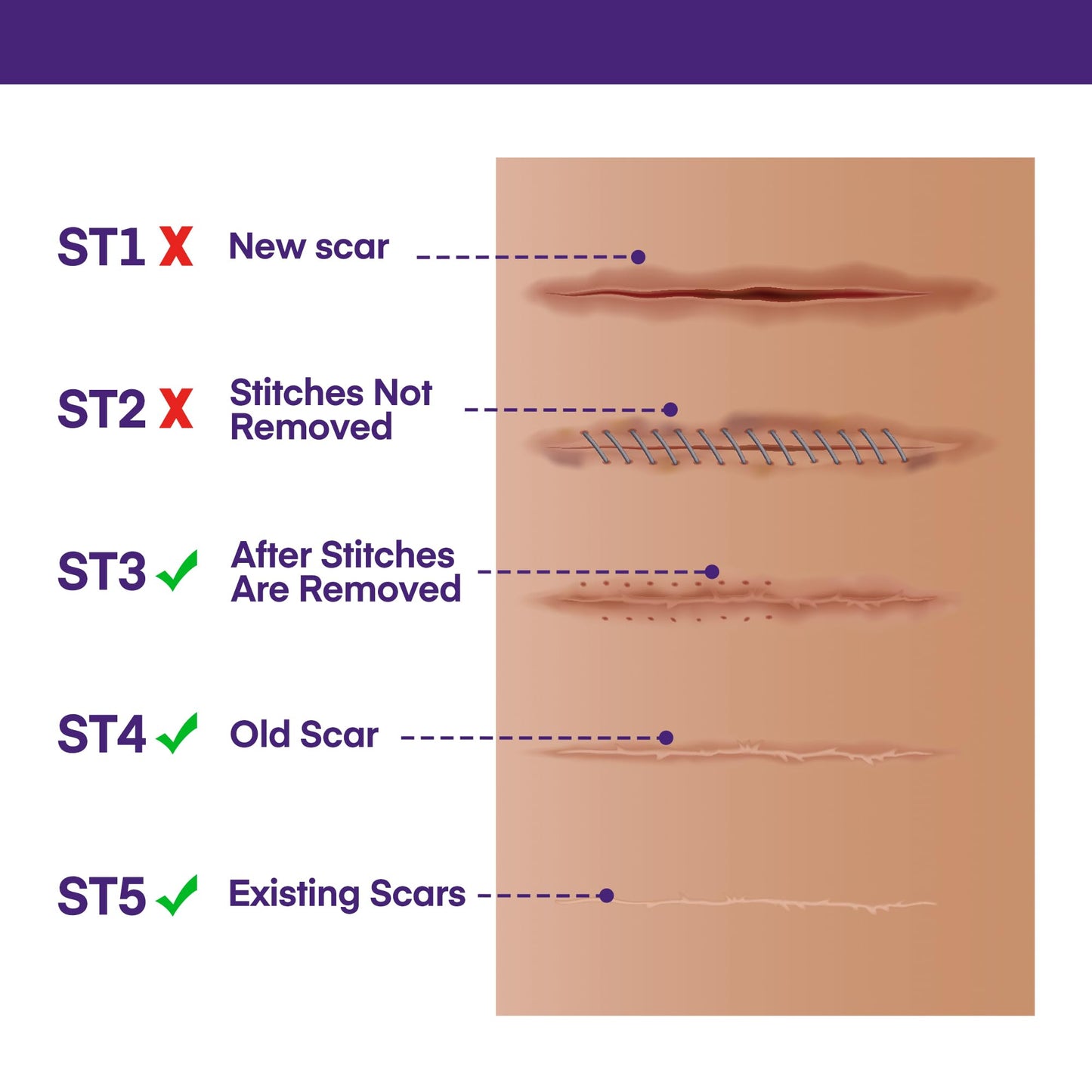 MURASAKI BEAUTY Silicone Scar Gel SPF 30 – Medical-Grade Scar Cream (1.06oz)