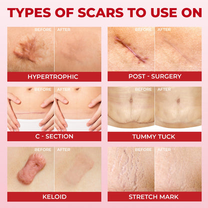 MYHELP Medical Grade Silicone Scar Sheets – Transparent 6pk (7in x 1.6in) for C-Section Scars