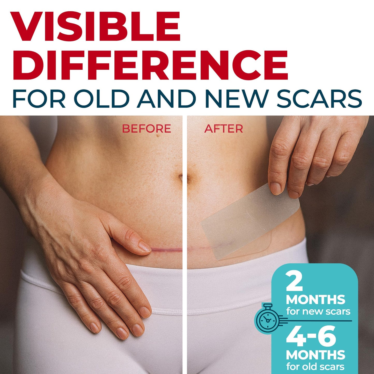 MYHELP Medical Grade Silicone Scar Sheets - Transparent 6pk (5.7x1.6 in) | Visible Difference