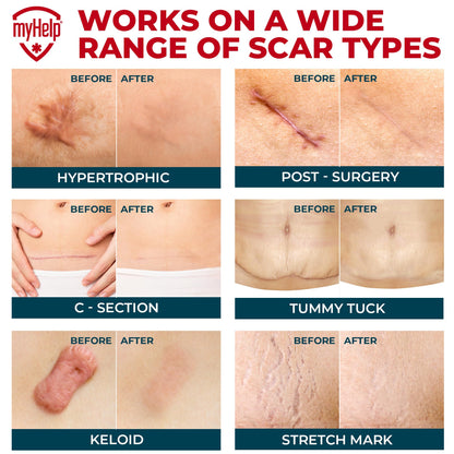 MYHELP Medical Grade Silicone Scar Sheets - Transparent 6pk (5.7x1.6 in) | Visible Difference