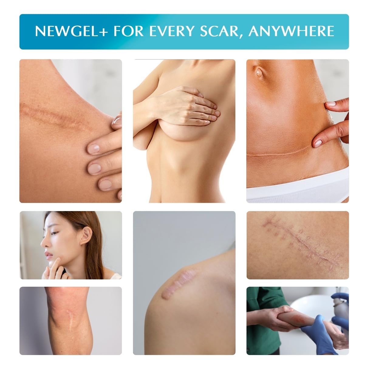 MyNewGel Advanced Silicone Scar Sheets – 1 x 6 inch, 4 Count, CLEAR