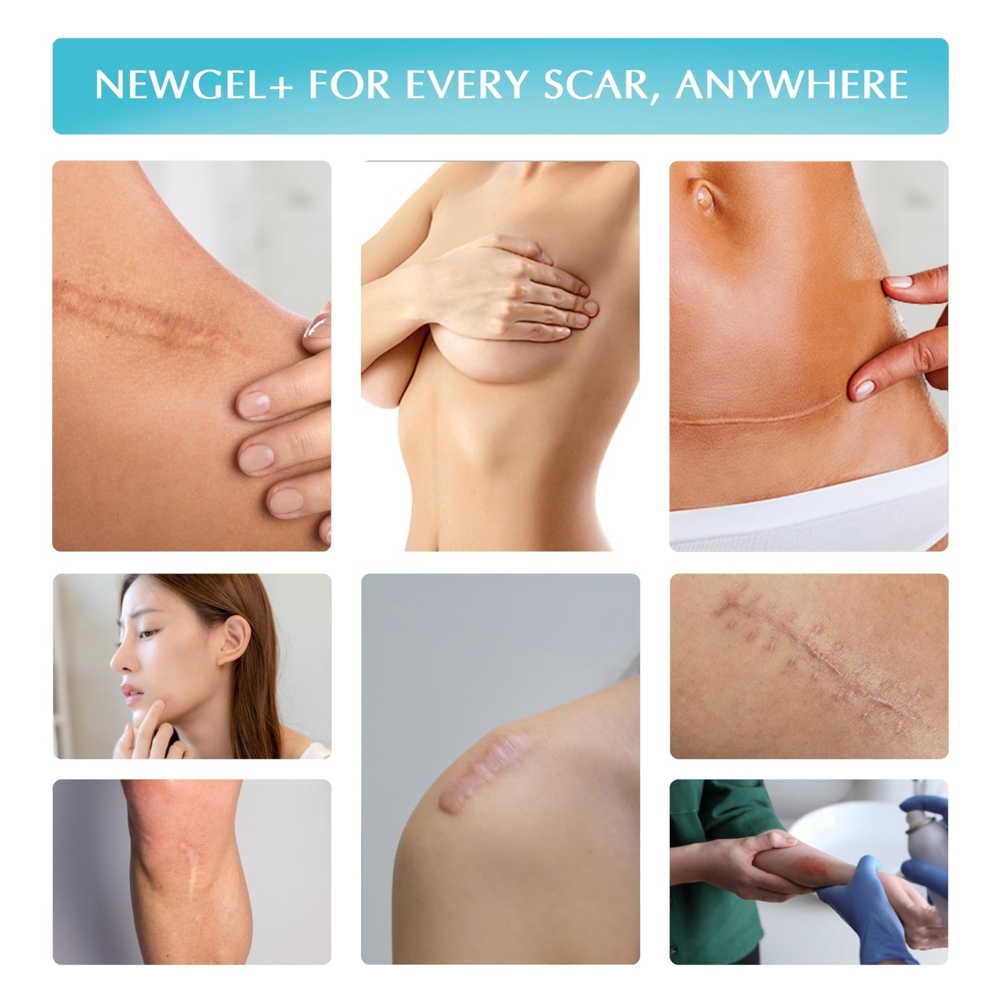 NewGel Plus by MyNewGel – Silicone Scar Gel with Vitamin E (15 g / 0.5 oz)