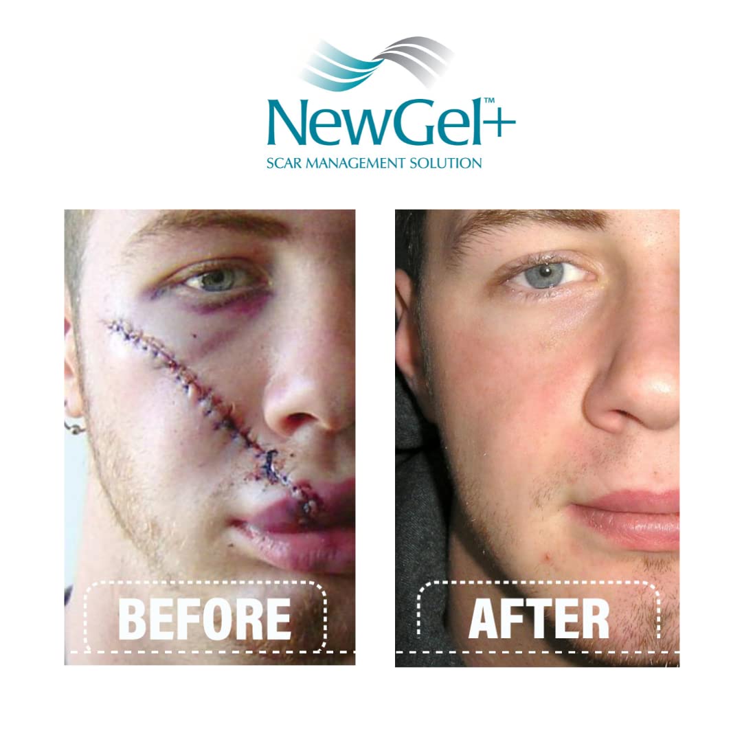 NewGel Plus Scar Gel by MyNewGel – Advanced Silicone Scar Treatment with Vitamin E (30 g)