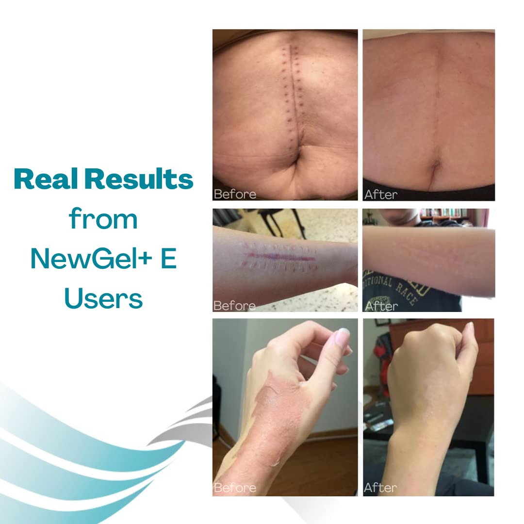 NewGel Plus Scar Gel by MyNewGel – Advanced Silicone Scar Treatment with Vitamin E (30 g)
