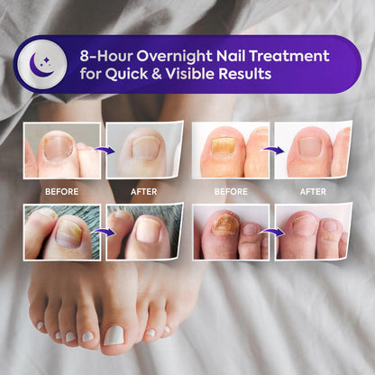 Natural Vine Fungal Nail Patches – Extra-Strength 1% Tolnaftate, Overnight Renewal (32 Patches x 2)