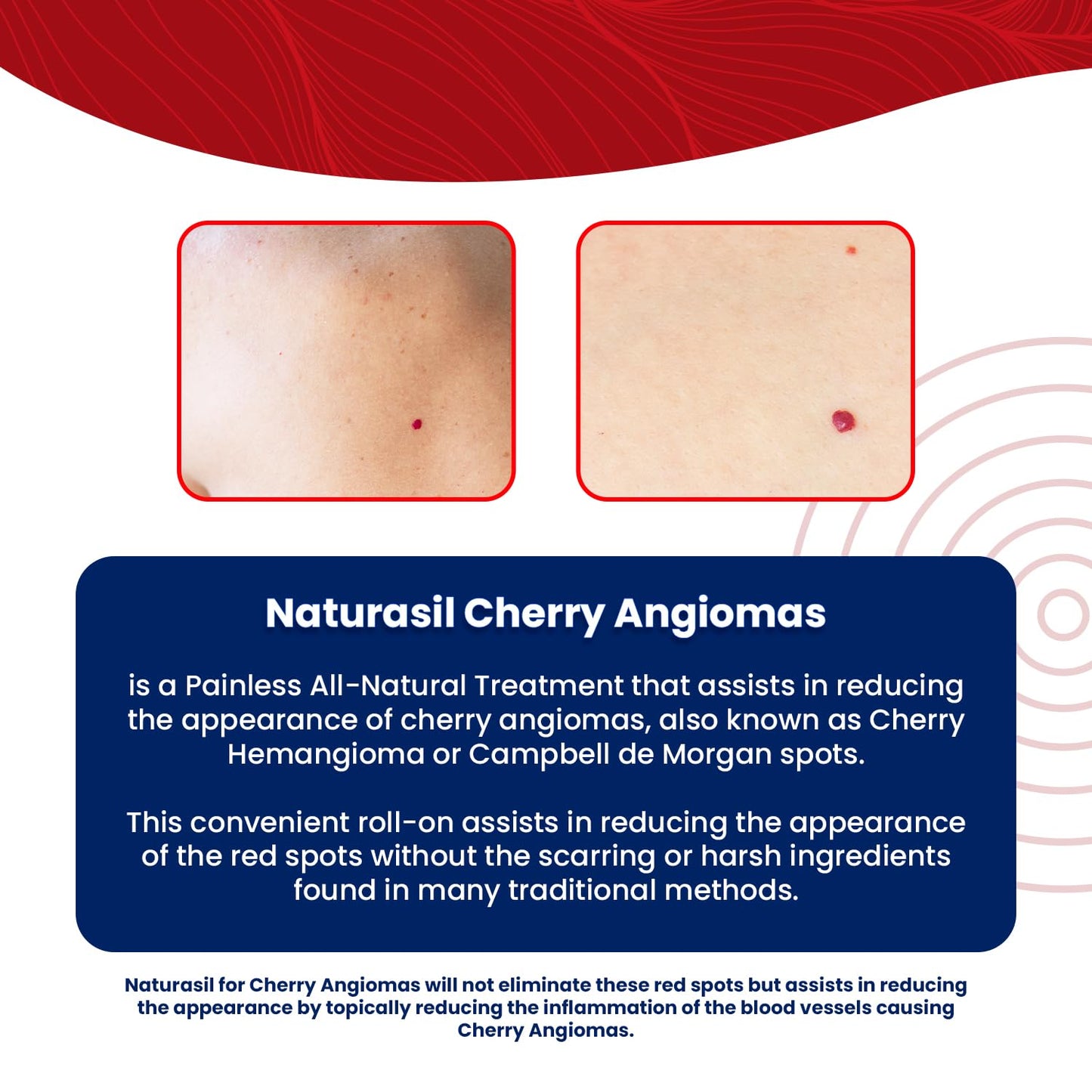 Naturasil Cherry Angiomas 10ml | Liquid Roller