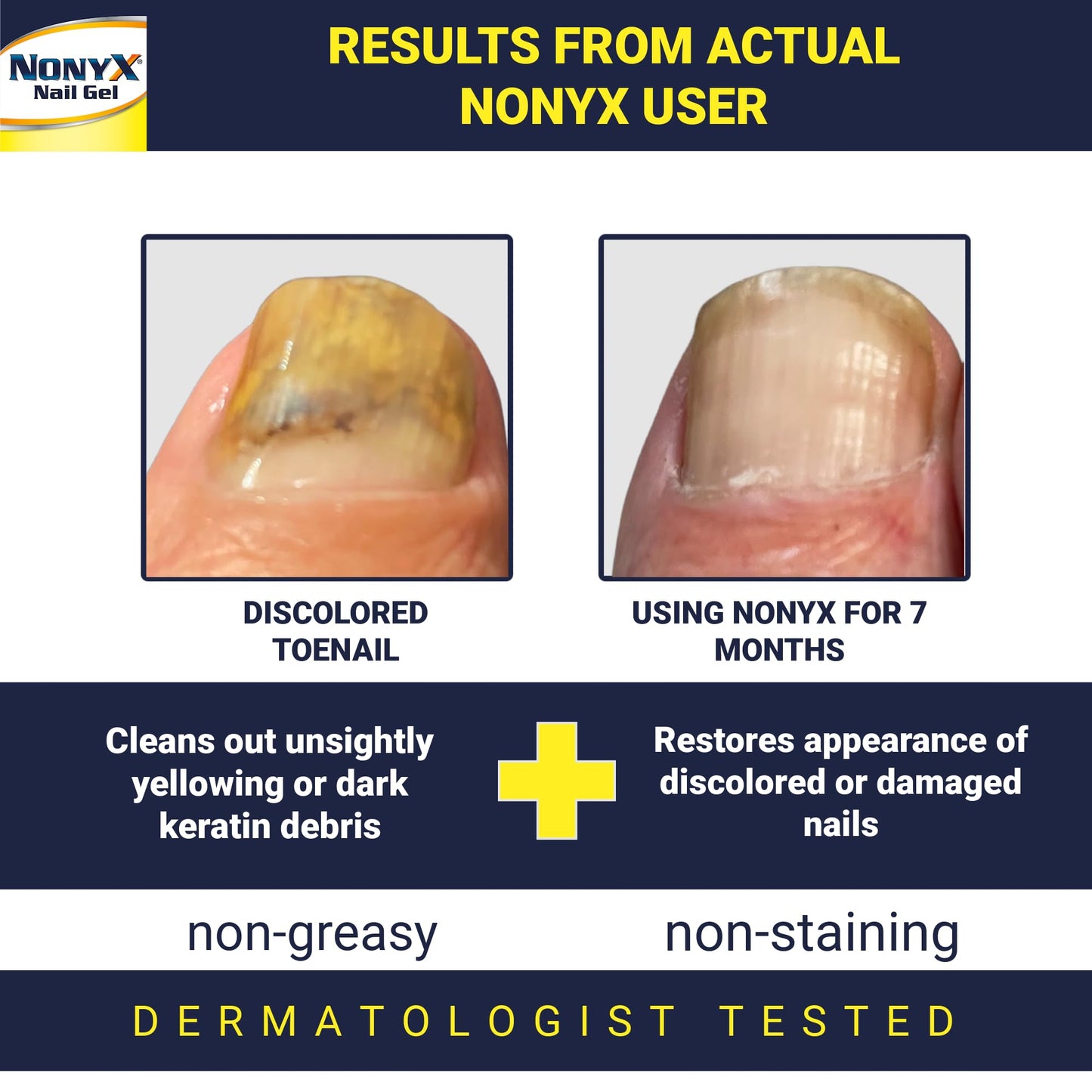 NONYX Fungal Nail Clarifying Gel | Clinically Proven for Discolored, Thick Nails (90% Improvement) | Made in USA