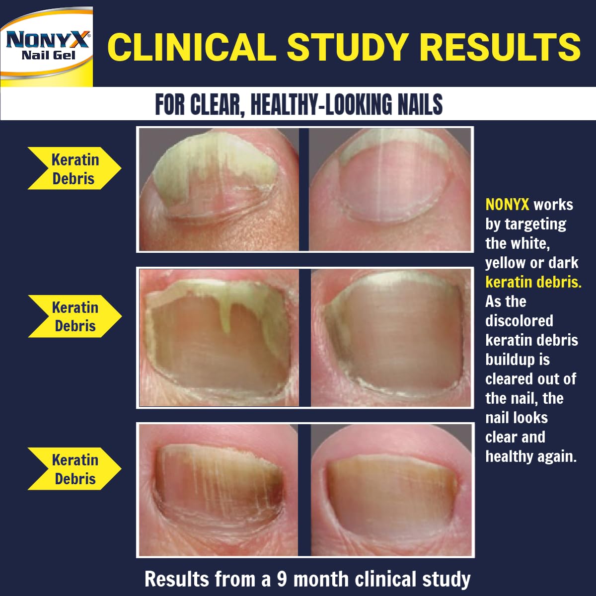 NONYX Fungal Nail Clarifying Gel | Clinically Proven for Discolored, Thick Nails (90% Improvement) | Made in USA