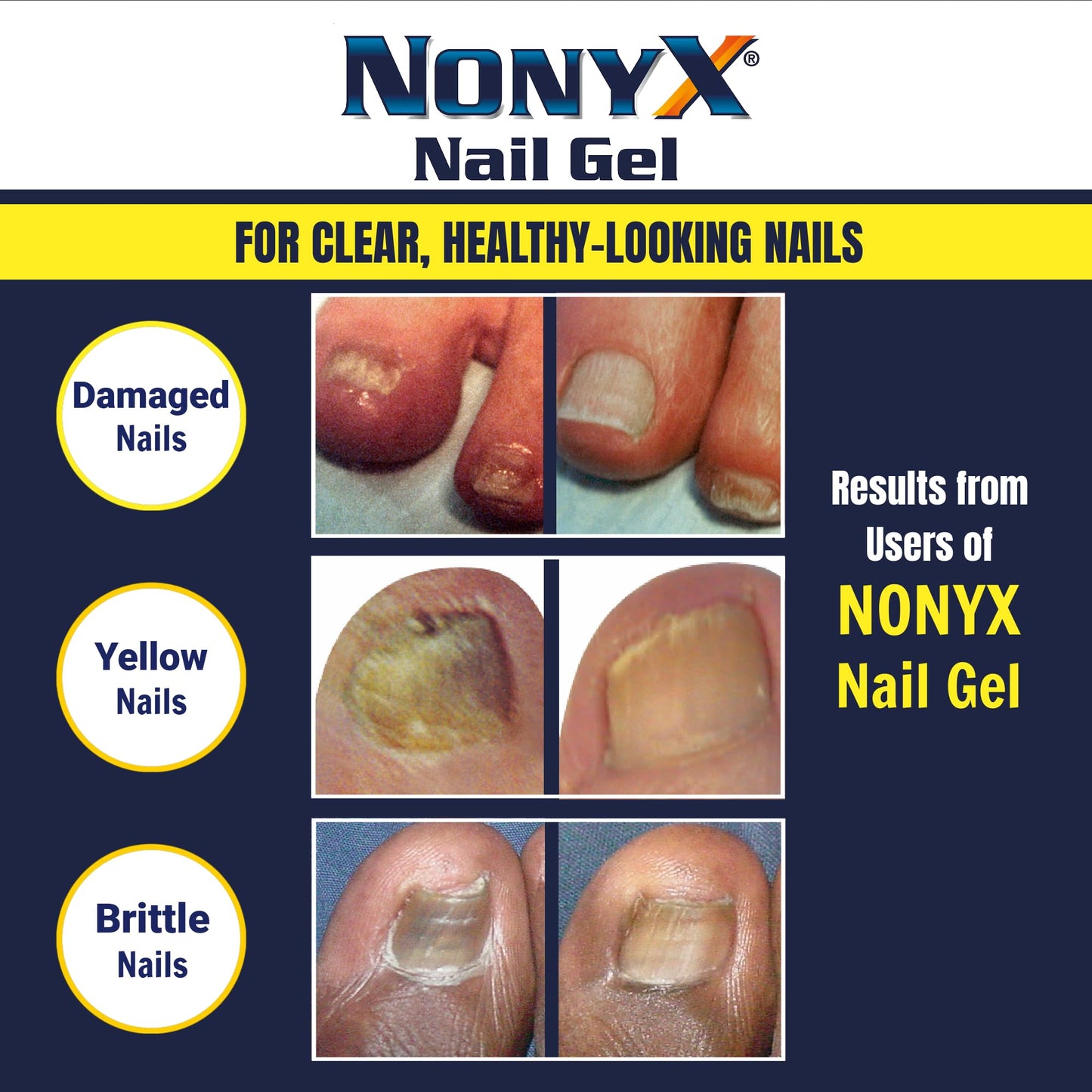 NONYX Fungal Nail Clarifying Gel | Clinically Proven for Discolored, Thick Nails (90% Improvement) | Made in USA