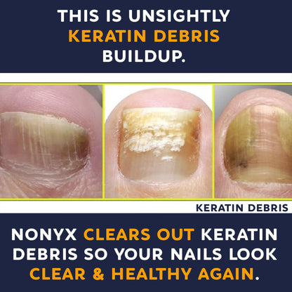NONYX Fungal Nail Clarifying Gel | Clinically Proven for Discolored, Thick Nails (90% Improvement) | Made in USA