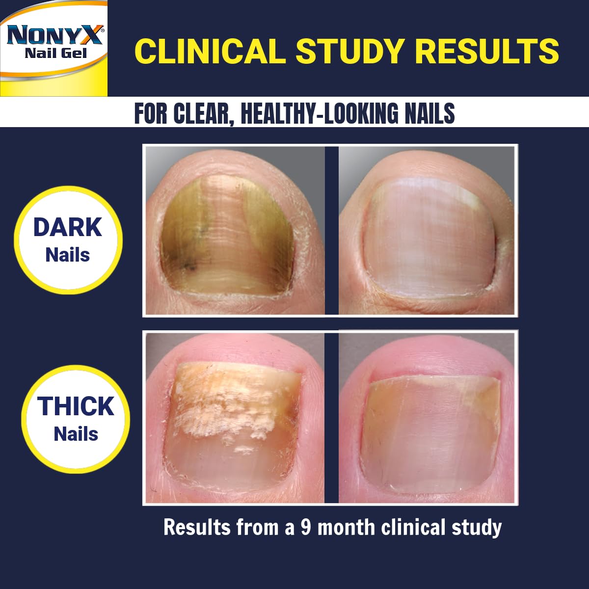 NONYX Fungal Nail Clarifying Gel | Clinically Proven for Discolored, Thick Nails (90% Improvement) | Made in USA