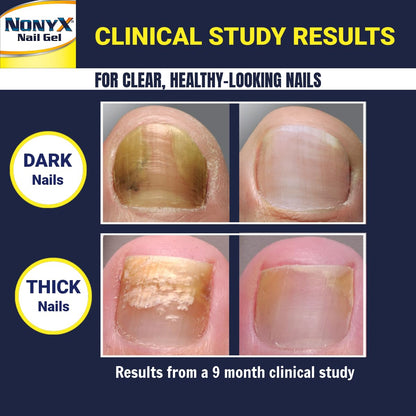 NONYX Fungal Nail Clarifying Gel | Clinically Proven for Discolored, Thick Nails (90% Improvement) | Made in USA