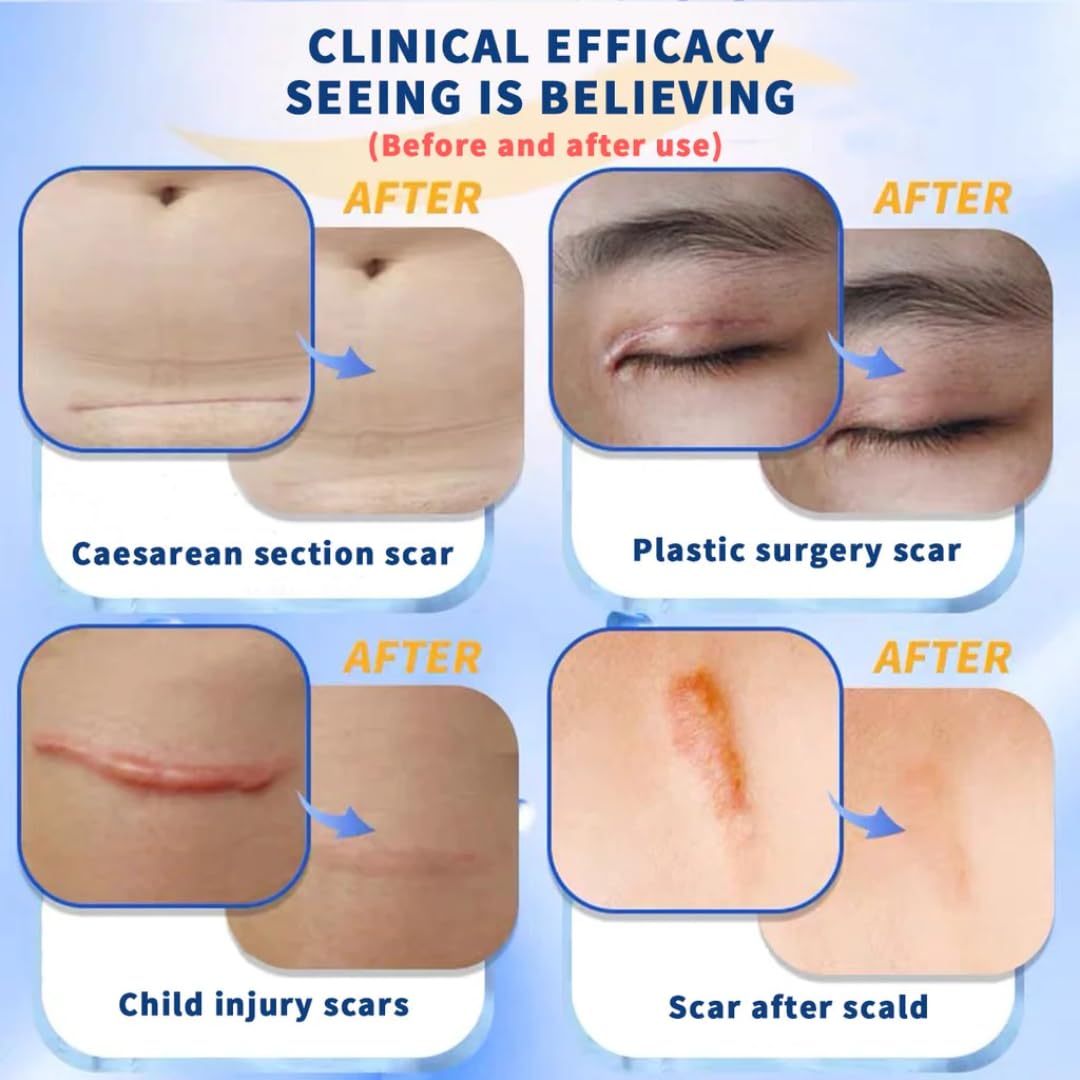 NOUVOS Dermatix Ultra Advanced Scar Gel - 15g | Softens, Flattens, Quick-Drying & Odorless