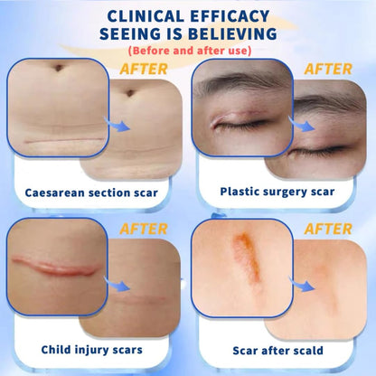 NOUVOS Dermatix Ultra Advanced Scar Gel - 15g | Softens, Flattens, Quick-Drying & Odorless