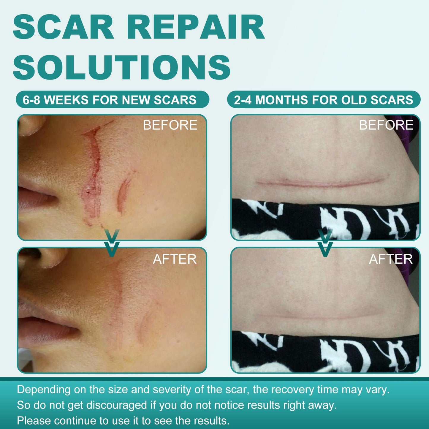 Nullam Silicone Scar Sheets & Tape – Reusable, Breathable Scar Care (1.6 x 158 in)