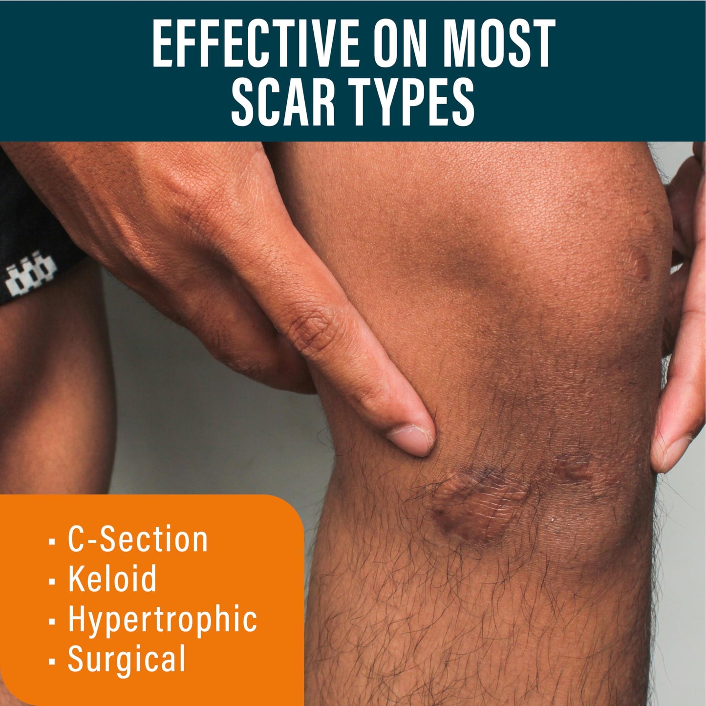 NUVADERMIS Advanced Scar Gel - Retinol & Vitamin E for Surgical Scars | C-Section, Tummy Tuck & Keloid Care